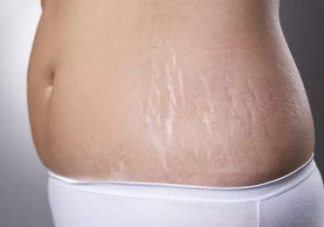 怀孕之后才会有妊娠纹吗 妊娠纹是什么时候会出现