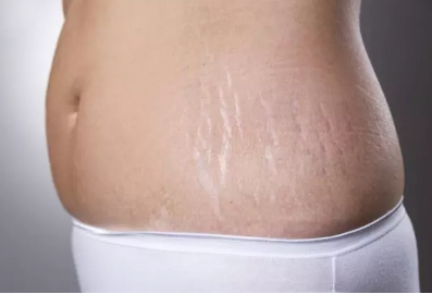 为什么女性怀孕会出现妊娠纹 妊娠纹怎怎么去除