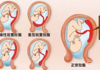 胎盘低是怎么回事 胎盘低怎么办